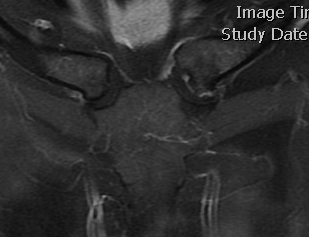 SCJ OA MRI 2